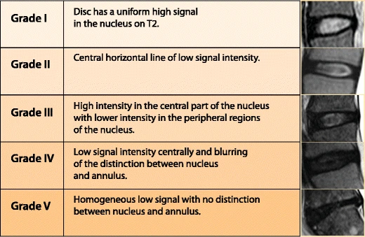 Five MRI grades of disc degeneration. Grade I is a bright, uniform disc. Grade V is uniformly dark, with no distinction between the nucleus and the outer ring.