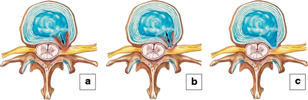 Three drawings of a disc from above. A is an acute herniation, B is a subacute herniation, and C is a chronic herniation pressing toward the nerve.